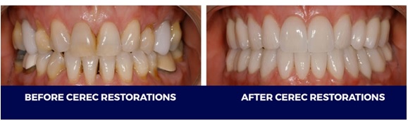  A BEFORE AND AFTER look at a patient’s teeth following the use of CEREC®.  Image courtesy Concerned Dental Care 